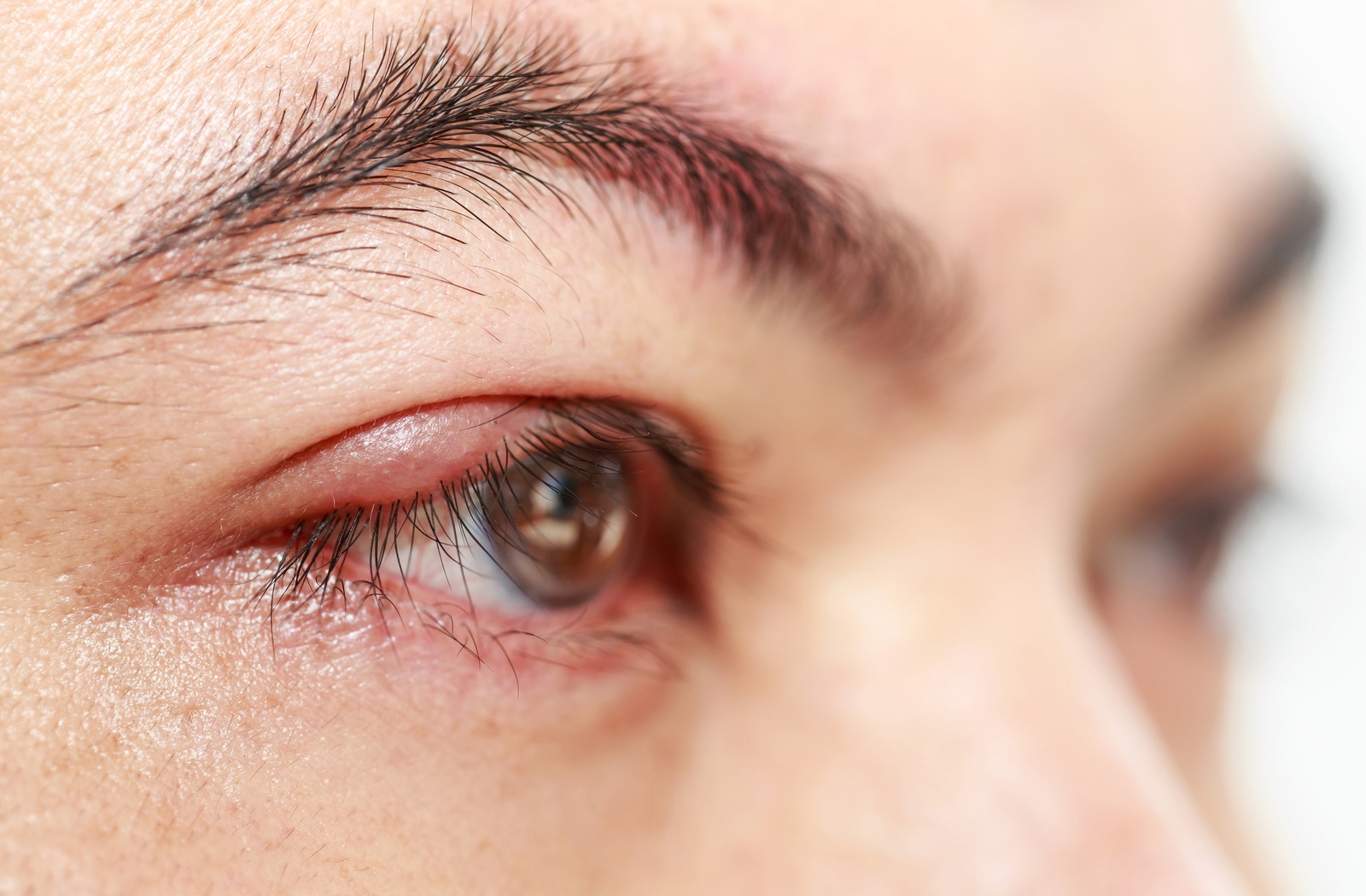 A close up of a woman's right eye with a swollen upper eyelid as she her meibomian glands are clogged